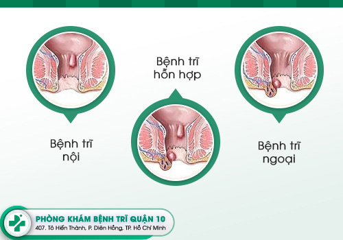 Các loại bệnh trĩ phổ biến hiện nay.