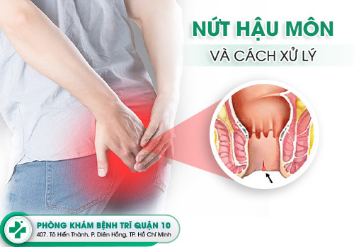 nứt kẽ hậu môn