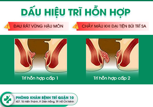 trĩ hỗn hợp
