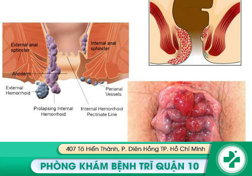 Bệnh trĩ là một trong những nguyên nhân chính gây ngứa lỗ hậu môn