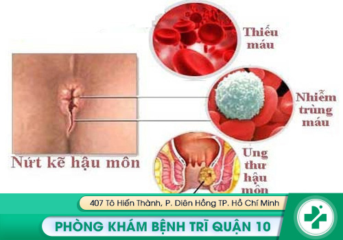 Rách hậu môn cũng có thể do bị bệnh trĩ Biến chứng nguy hiểm của bệnh rách hậu môn