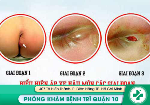 Hình ảnh về áp-xe hậu môn