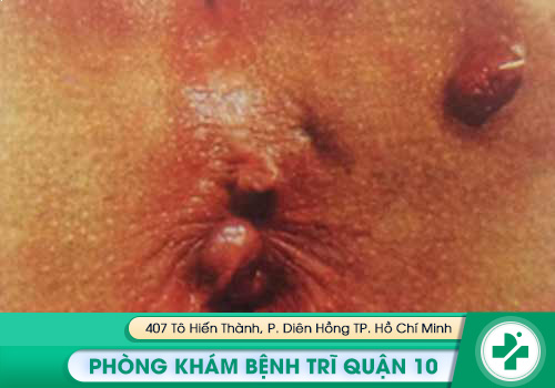 Hình ảnh về rò hậu môn