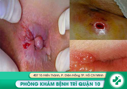 Sưng hậu môn, đau hậu môn, ngứa xung quanh vùng hậu môn là bị bệnh gì?