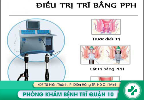 Phương pháp PPH và TST điều trị ngứa hậu môn do trĩ